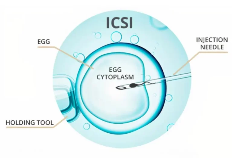 Intracytoplasmic Sperm Injection (ICSI)​