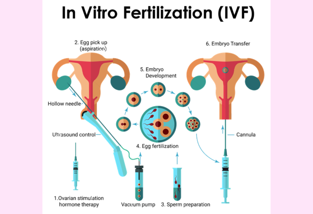 IVF (In Vitro Fertilization)